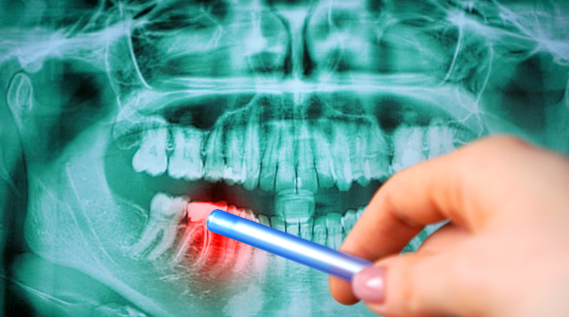 How to Determine if Your Teeth are Too Far Gone to Be Saved