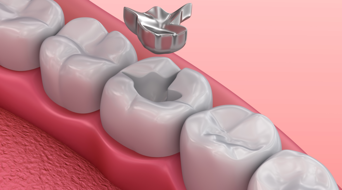 Can I Have My Dark Colored Fillings Replaced with Tooth Colored Fillings?