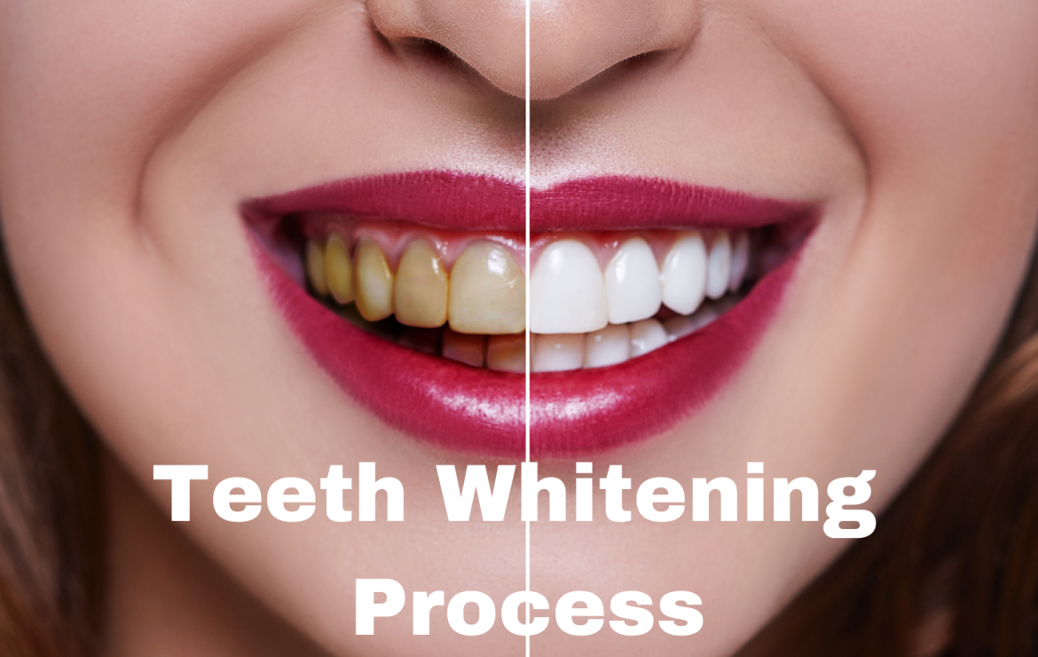 What is the tooth whitening process?