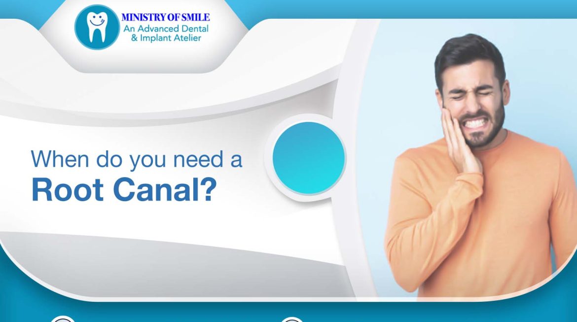 When Do You Need a Root Canal?