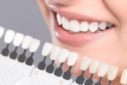 Are Dental Veneers Long Lasting?