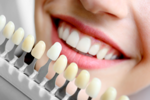 Best Teeth Whitening in Gurgaon