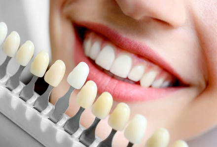Best Teeth Whitening in Gurgaon