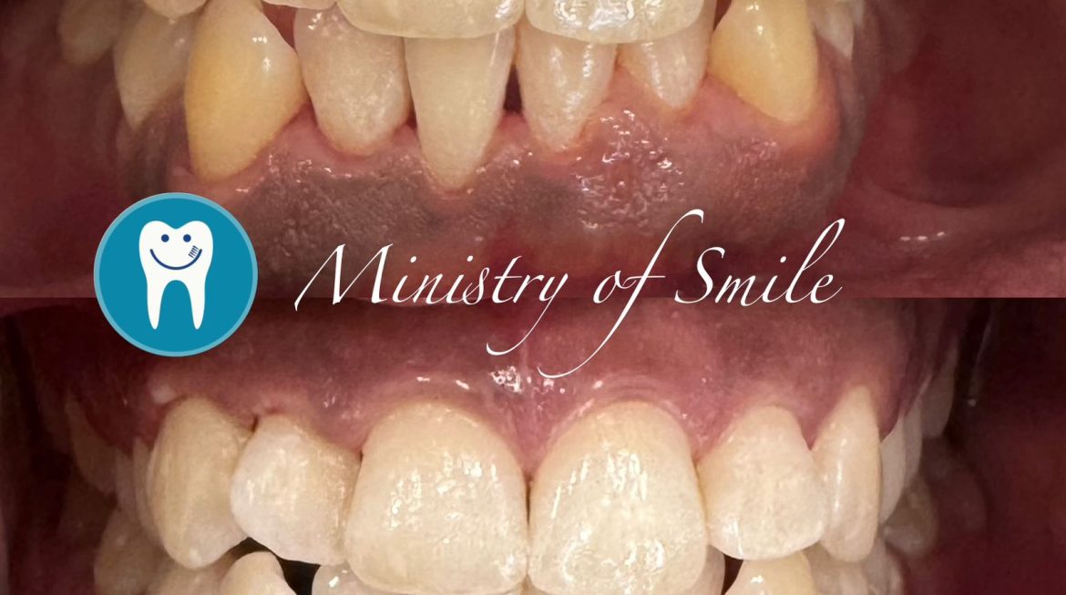 Teeth Whitening Solutions