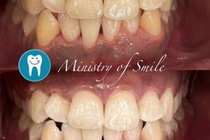 Teeth Whitening Solutions