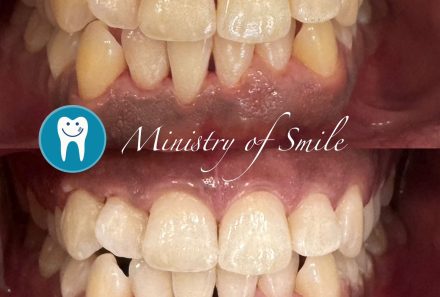 Teeth Whitening Solutions