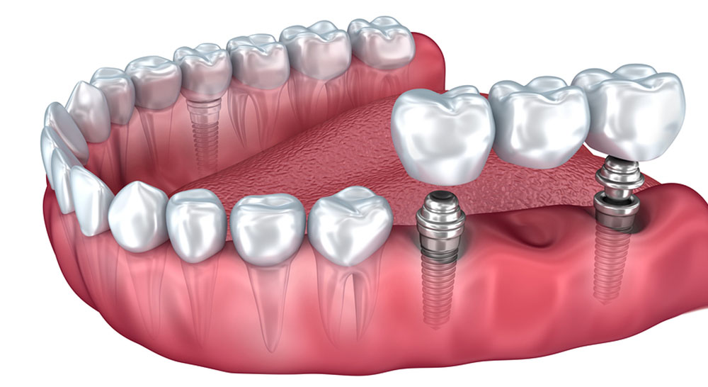 Multiple Tooth Dental Implants in gurgaon