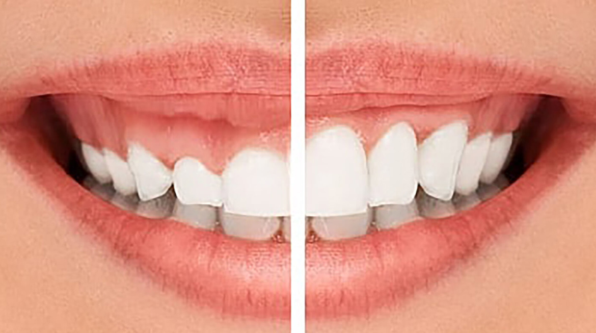 Gummy Smile Correction Gurgaon Gummy Smile Laser Contouring Gurgaon, India