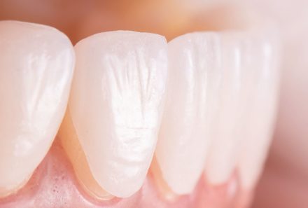 Veneers & Cosmetic Dentistry : What to Know