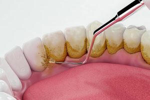 Teeth Scaling in Gurgaon