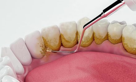 Teeth Scaling in Gurgaon