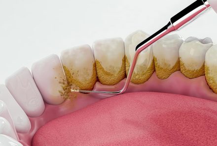 Teeth Scaling in Gurgaon