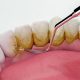 Teeth Scaling in Gurgaon