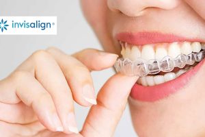 Invisalign Braces Cost in Gurgaon