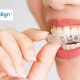 Invisalign Braces Cost in Gurgaon