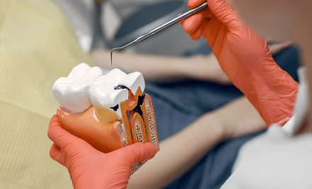 Painless Laser Root Canal Treatment in Gurgaon