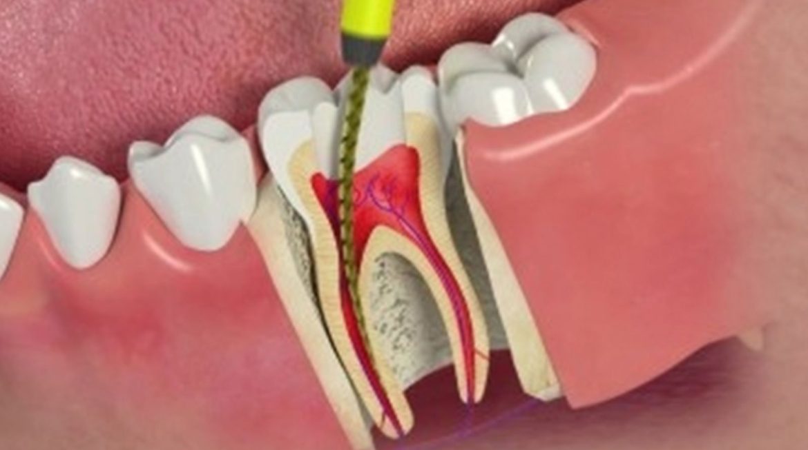 Root Canal Therapy and Misconceptions