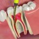 Root Canal Therapy and Misconceptions