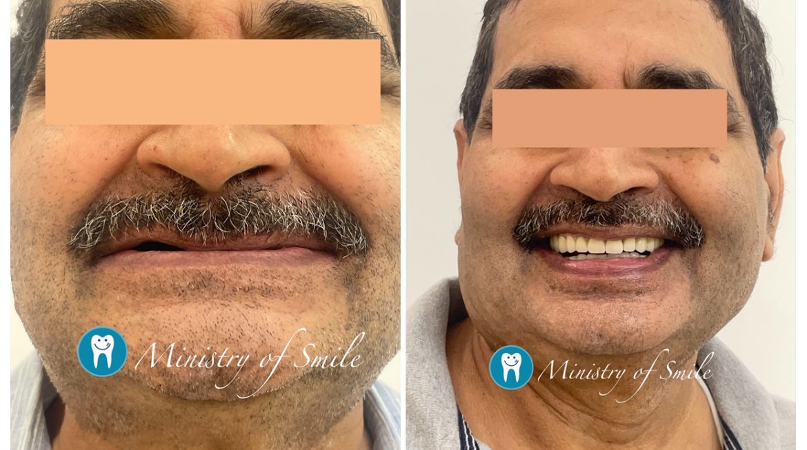 Full Mouth Teeth Replacement Cost in Gurgaon