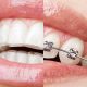 Braces vs. Invisalign: Which Orthodontic Treatment is Best for You?