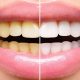 How to Get Rid of Yellow Teeth: Causes & Solutions