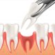 Tooth Extraction Cost in Gurgaon – Affordable Care at Ministry of Smile Dental Clinic