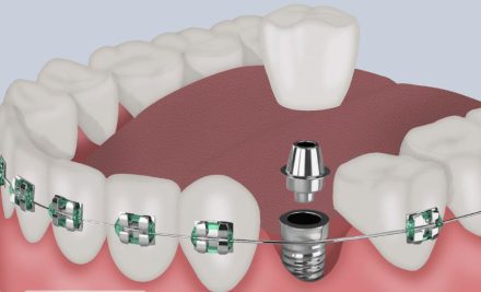 Top 10 Questions to Ask Before Getting Braces/Implants