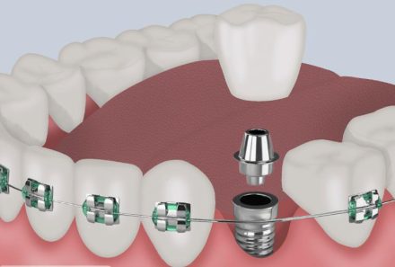 Top 10 Questions to Ask Before Getting Braces/Implants