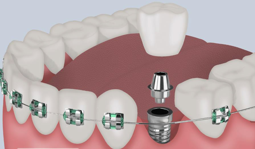 Top 10 Questions to Ask Before Getting Braces/Implants