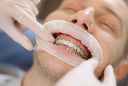 Best Orthodontist in Gurgaon