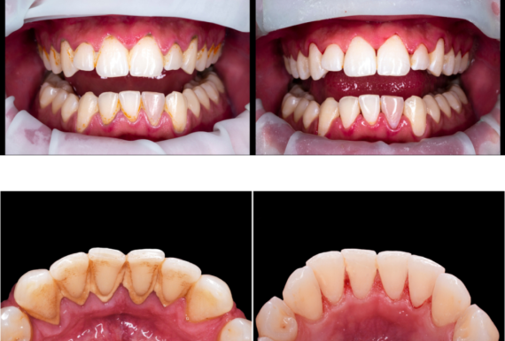 Air-Flow Teeth cleaning