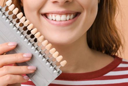 Veneers Treatment in Young Patients