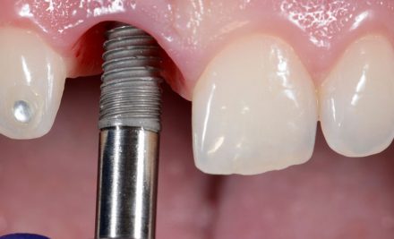 Immediate Dental Implants in Gurgaon
