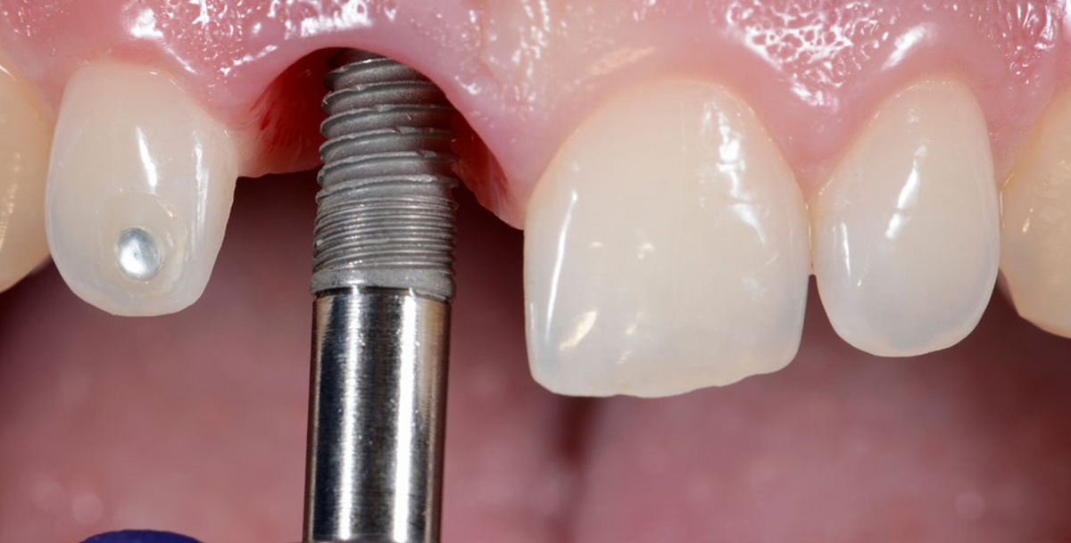 Immediate Dental Implants in Gurgaon