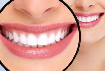 How to Get a Sparkling White Smile in One Sitting