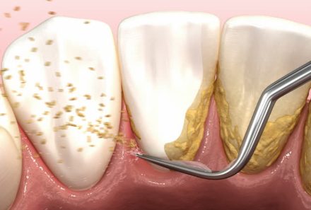 Why Scaling Is Important Twice a Year?