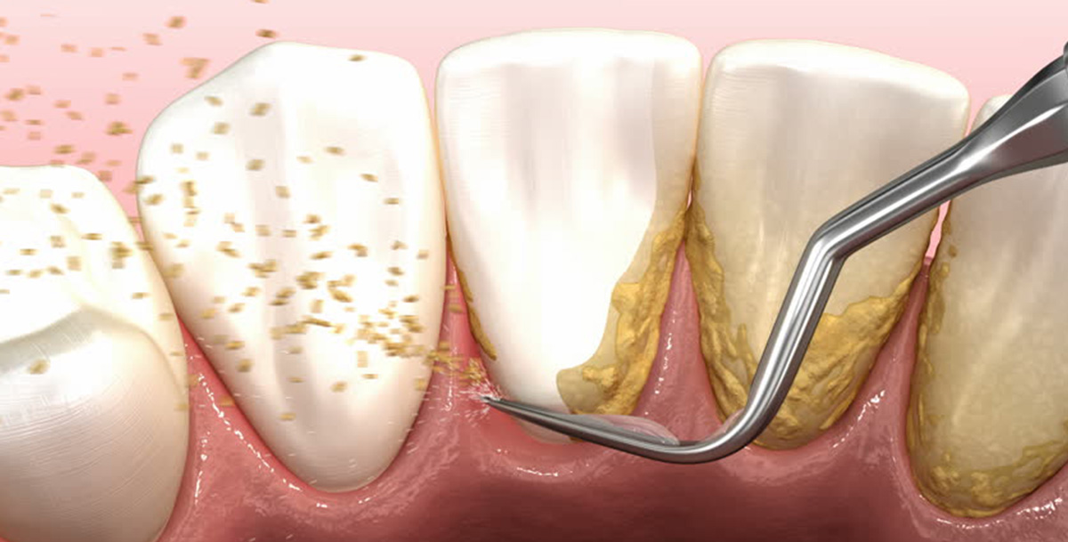 Why Scaling Is Important Twice a Year?