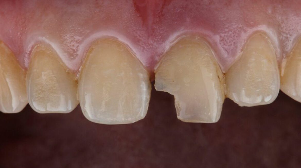 Treatment Options for Broken Front Tooth in Gurgaon