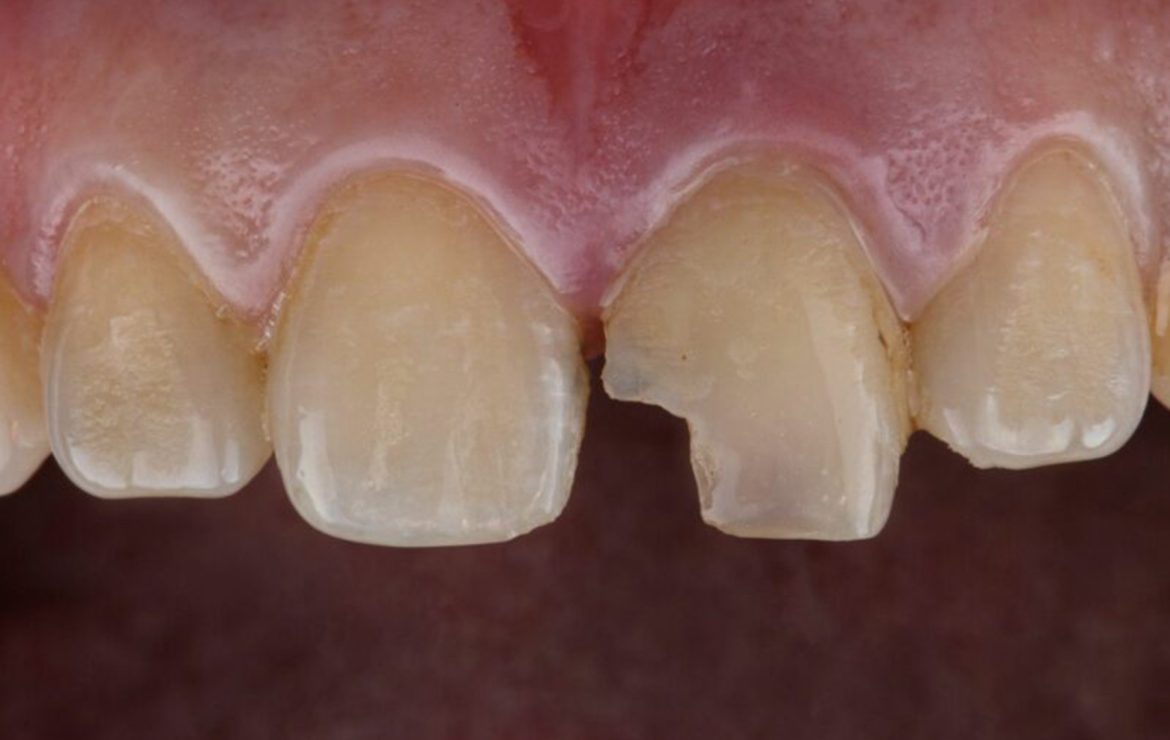 Treatment Options for Broken Front Tooth in Gurgaon