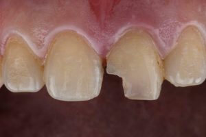 Treatment Options for Broken Front Tooth in Gurgaon
