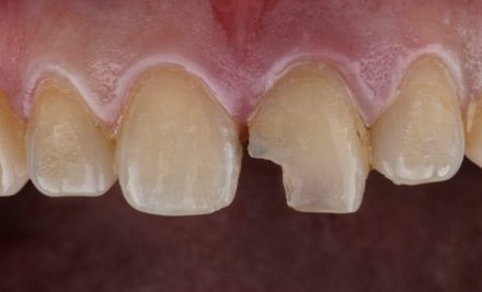 Treatment Options for Broken Front Tooth in Gurgaon