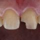 Treatment Options for Broken Front Tooth in Gurgaon