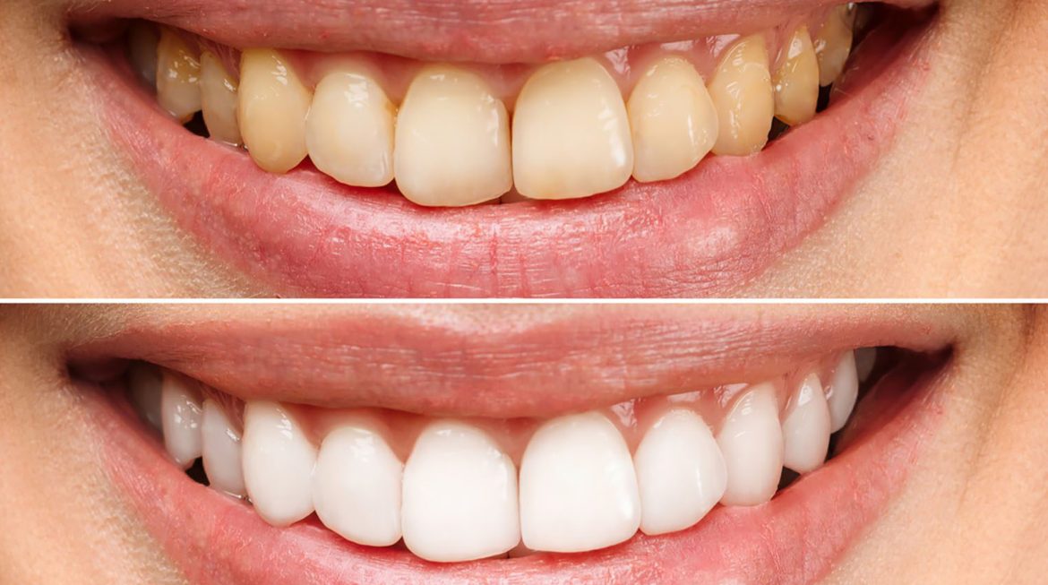 Yellow Teeth Remedies by Ministry of Smile