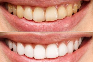 Yellow Teeth Remedies by Ministry of Smile