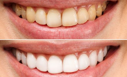 Yellow Teeth Remedies by Ministry of Smile