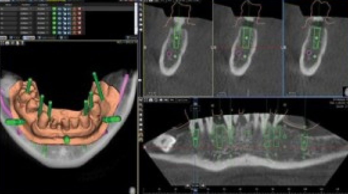 CBCT for Dental Implant Placement