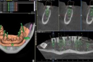 CBCT for Dental Implant Placement