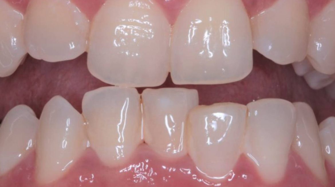 Correction of Irregular Teeth in Gurgaon