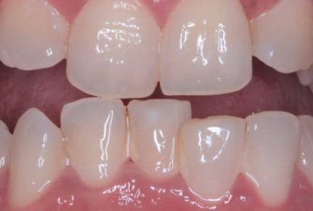 Correction of Irregular Teeth in Gurgaon