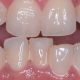 Correction of Irregular Teeth in Gurgaon